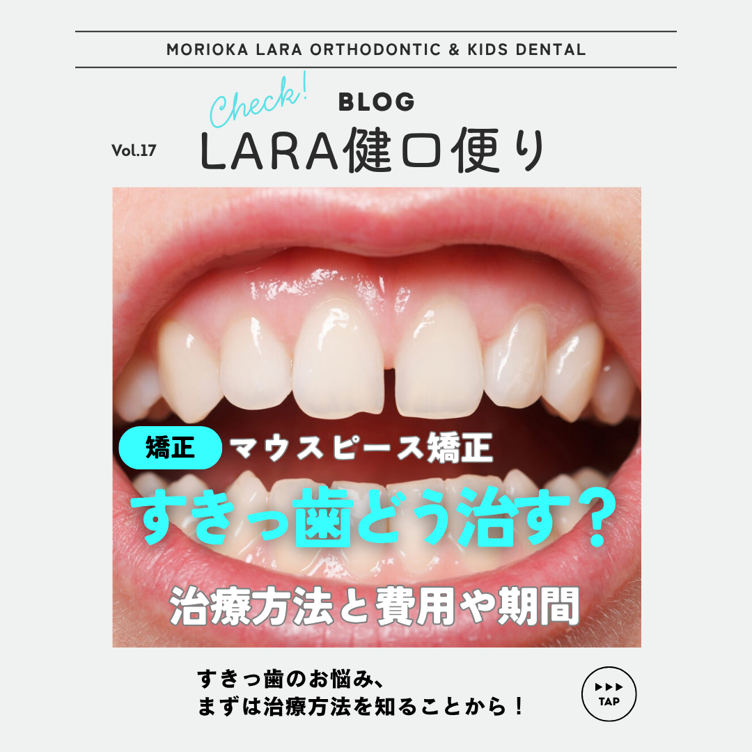 【LARA健口頼り vol.17】前歯のすきっ歯は治療できる？原因と治療方法・費用・期間をわかりやすく説明